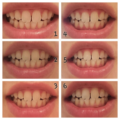 at home teeth whitening results